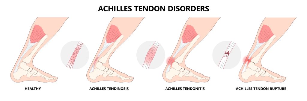 Tendinopathy Progression In Achilles